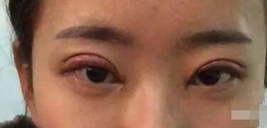 武漢藝星整形岳金堂醫(yī)生雙眼皮案例術(shù)后一周 武漢藝星整形岳金堂醫(yī)生雙眼皮案例術(shù)后一周