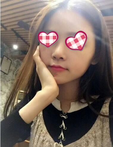 北京葉子整形膨體隆鼻術(shù)后三個(gè)月效果 北京葉子整形膨體隆鼻術(shù)后三個(gè)月效果