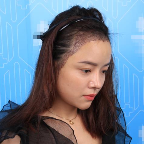 廈門新生植發(fā)種植發(fā)際線半個(gè)月 廈門新生植發(fā)種植發(fā)際線半個(gè)月