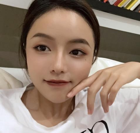 廈門新生植發(fā)種植發(fā)際線半年效果分享，一鍵get高顱頂