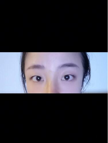 西安時(shí)光整形郭淑華雙眼皮案例術(shù)前