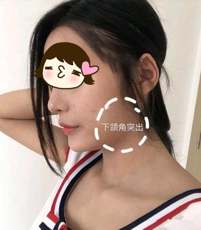 廣州美恩整形下頜角術(shù)后三個月反饋，真實效果看得見