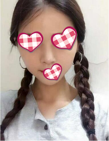 北京葉子整形膨體隆鼻術(shù)后一個(gè)月效果 北京葉子整形膨體隆鼻術(shù)后一個(gè)月效果