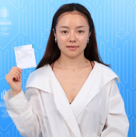 廈門新生植發(fā)種植發(fā)際線半年效果分享，一鍵get高顱頂