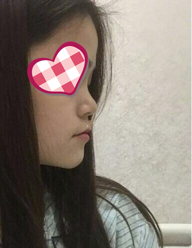 北京葉子整形膨體隆鼻兩個月效果分享，高級感側顏殺