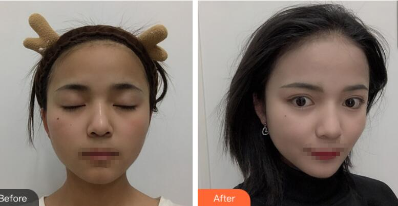 長沙愛思特整形定點雙眼皮案例分享，蘿莉到御姐的轉(zhuǎn)變