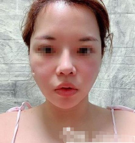 南京閱顏整形瘦臉針注射后八天