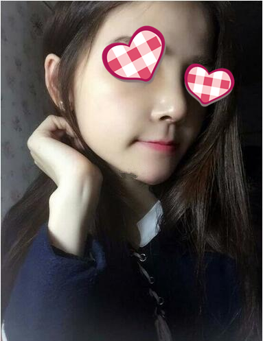 北京葉子整形膨體隆鼻術(shù)后兩個(gè)月效果 北京葉子整形膨體隆鼻術(shù)后兩個(gè)月效果