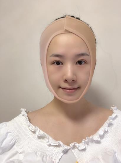 南方醫(yī)院整形美容科顴骨內(nèi)推術后一周