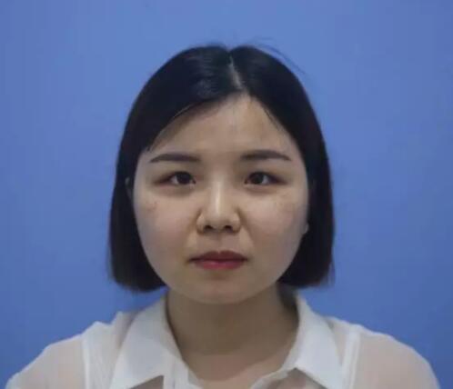 長(zhǎng)沙星雅整形激光祛斑前 長(zhǎng)沙星雅整形激光祛斑前