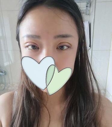 西安時(shí)光整形郭淑華雙眼皮案例術(shù)后一周