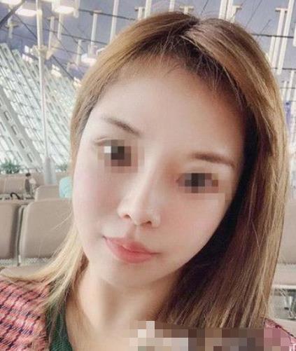 南京閱顏整形瘦臉針注射后半個月