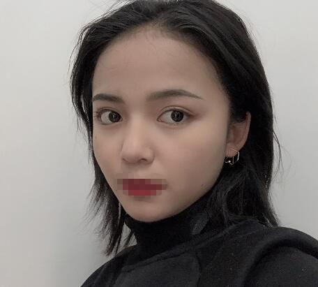 長沙愛思特整形定點雙眼皮案例分享，蘿莉到御姐的轉(zhuǎn)變