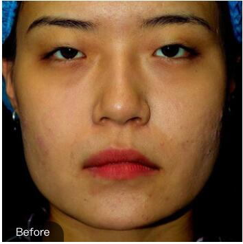 重慶華美下頜角整形術(shù)前