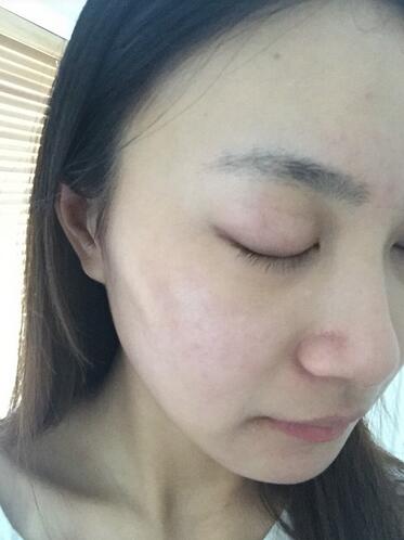 合肥艾雅整形紅藍(lán)光祛痘兩個療程結(jié)束后效果