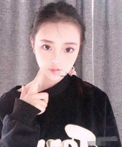 上海首爾麗格整形安建榮V-LINE瓜子臉手術(shù)案例分享