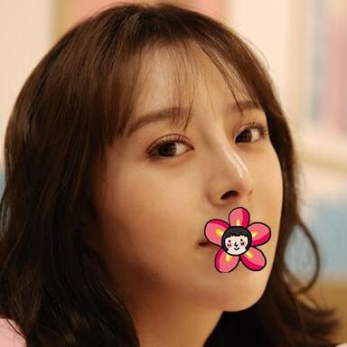 北京基礎(chǔ)美下頜角整形術(shù)后兩個(gè)月效果