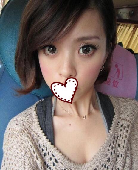 鄭州蘊(yùn)美整形玻尿酸隆鼻一周效果 鄭州蘊(yùn)美整形玻尿酸隆鼻一周效果