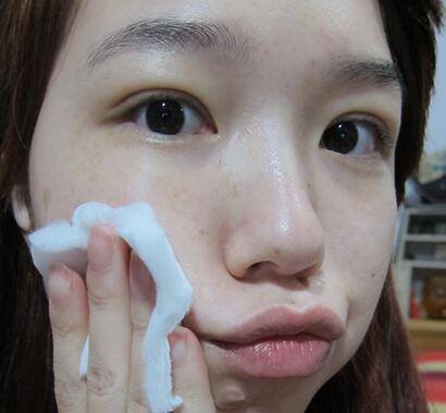 宜昌蕾帝整形張景雷雙眼皮一個多月效果