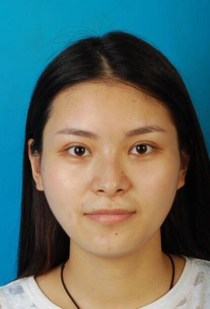 西安國際下頜角整形案例分享，怪不得都說整形要先輪廓后五官