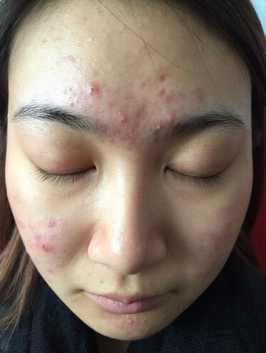 合肥艾雅整形紅藍光祛痘兩個療程效果，痘痘都消失了
