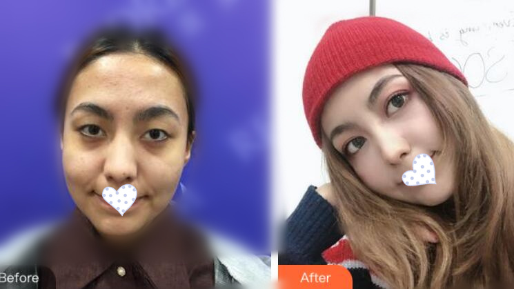 徐州時(shí)光洪揚(yáng)整形雙眼皮案例前后對比圖