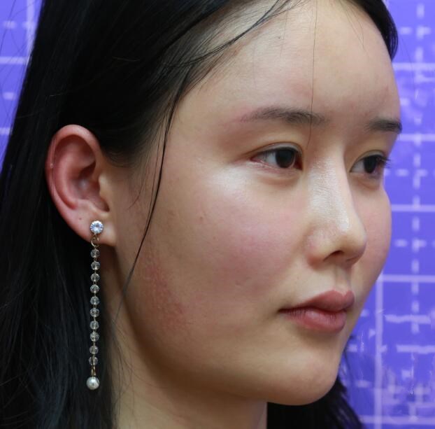 長沙亞韓整形陳明松下頜角整形前 長沙亞韓整形陳明松下頜角整形前