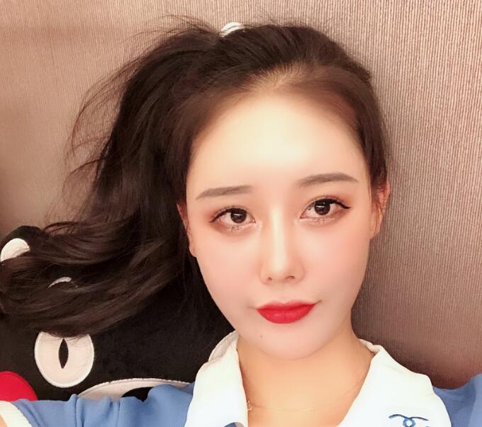 長沙亞韓整形陳明松下頜角整形一個月效果 長沙亞韓整形陳明松下頜角整形一個月效果