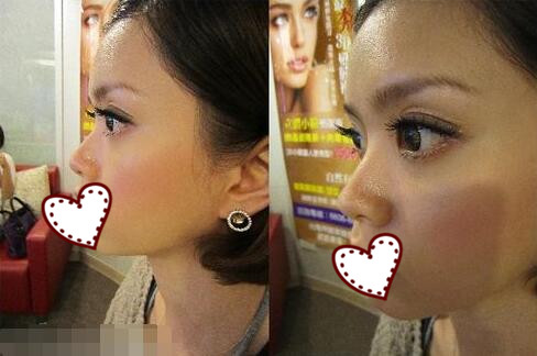 鄭州蘊美整形玻尿酸隆鼻案例分享，效果即刻看得見