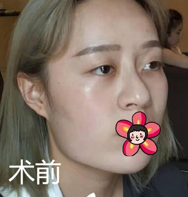 北京基礎(chǔ)美下頜角整形案例效果分享，黃大勇果然名不虛傳