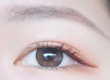 全切雙眼皮手術(shù)