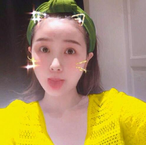 重慶美聯(lián)臣下頜角整形術(shù)后三個(gè)月效果反饋，一定要忌嘴