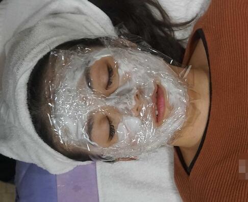 汕頭曙光整形皮秒激光祛斑后