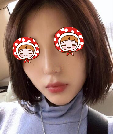 青島華諾整形歪鼻矯正術(shù)后兩個(gè)月效果反饋，鼻子也挺直腰桿了