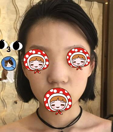 青島華諾整形歪鼻矯正前 青島華諾整形歪鼻矯正前