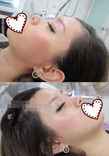 鄭州蘊(yùn)美整形玻尿酸隆鼻前后對(duì)比圖 鄭州蘊(yùn)美整形玻尿酸隆鼻前后對(duì)比圖