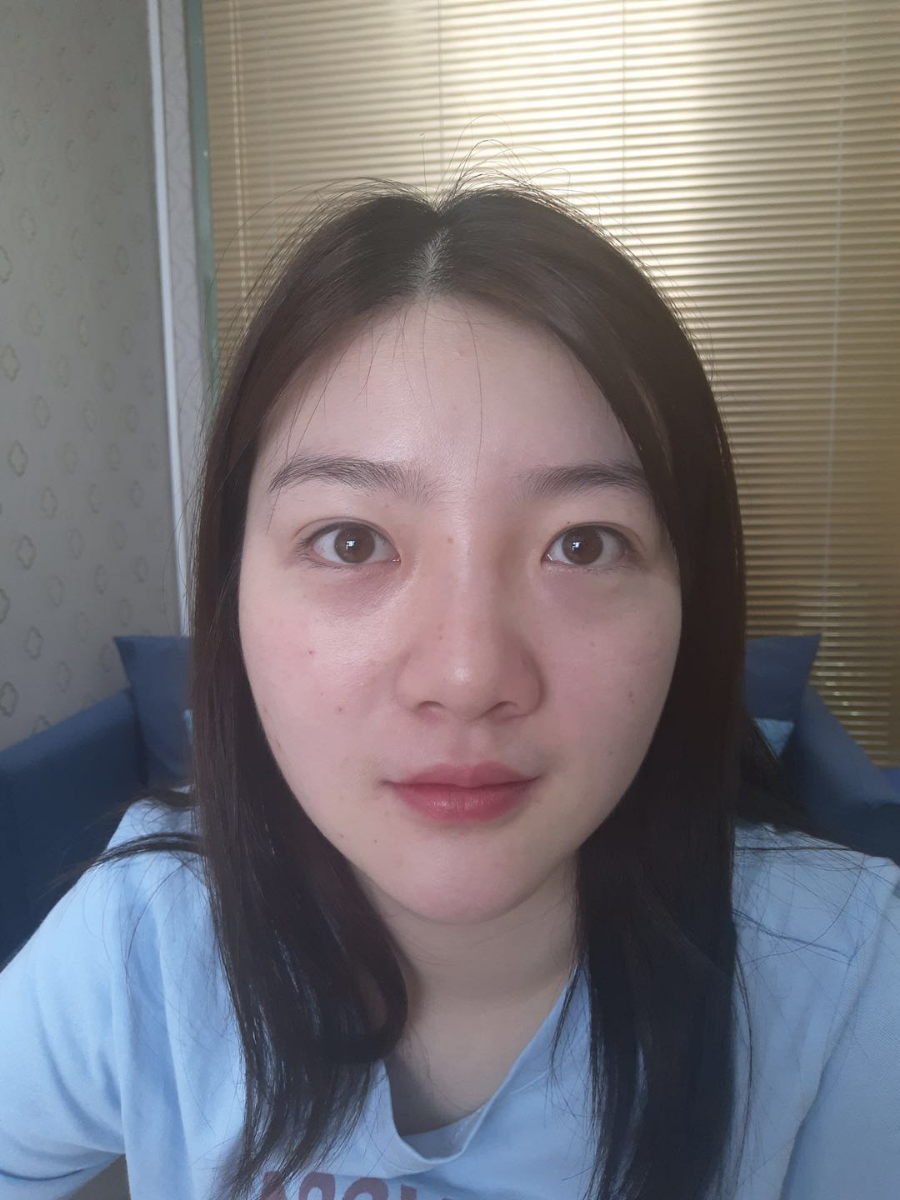 北京圣嘉榮二次鼻修復案例分享，做整形一定不要去莆田系醫(yī)院