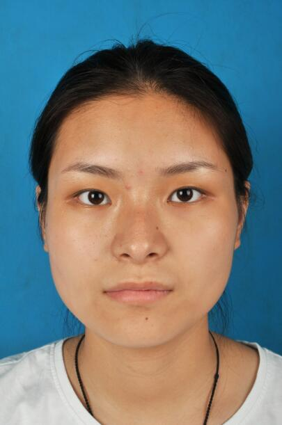 西安國際下頜角整形案例分享，怪不得都說整形要先輪廓后五官