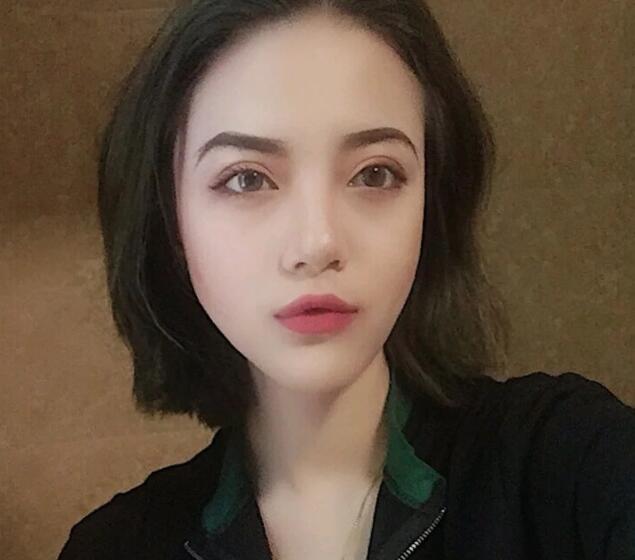 重慶華美下頜角整形術(shù)后一個(gè)月效果