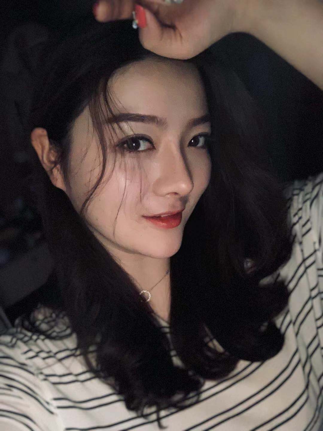 北京圣嘉榮二次鼻修復(fù)術(shù)后一個月