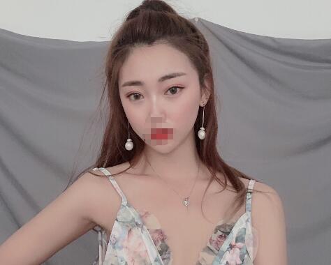 安徽省立醫(yī)院褚燕軍埋線雙眼皮一個月效果