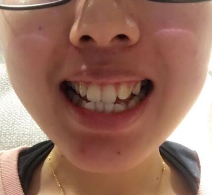 自貢華醫(yī)口腔金屬托槽矯正前 自貢華醫(yī)口腔金屬托槽矯正前