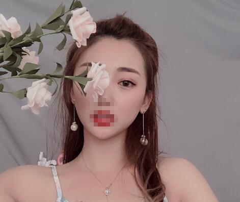 安徽省立醫(yī)院褚燕軍埋線雙眼皮一個月效果圖