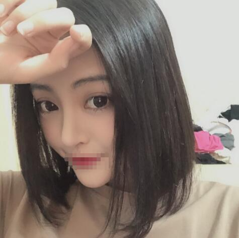 上海賽美瑞整形張化舉鼻綜合術后兩個月效果分享
