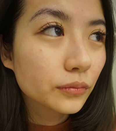 北京禾美嘉林善元激光祛斑術(shù)后一個月效果 北京禾美嘉林善元激光祛斑術(shù)后一個月效果