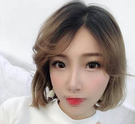 安徽省立醫(yī)院褚燕軍手術(shù)祛眼袋一個(gè)月效果