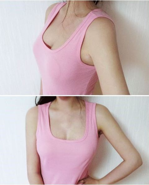 濟南鵬愛整形吳洪遠復(fù)合隆胸兩個月效果