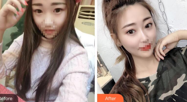 安徽省立醫(yī)院褚燕軍埋線雙眼皮前后對比圖