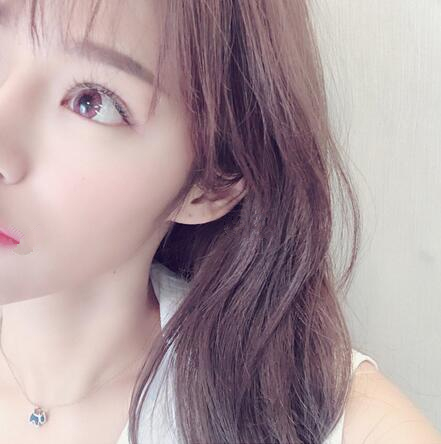 北京崔相平整形雙眼皮修復(fù)一個月效果