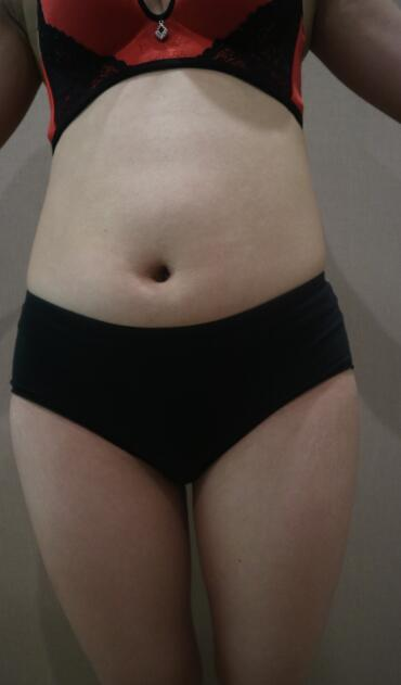 鄭州優(yōu)恩整形（原悅美）姚剛腿部吸脂案例分享